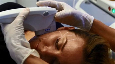 xProcedure,P20Up,P20Close,P20-,P20Ultherapy,P20Skin,P20Lifting,P20Treatment,P20-,P20WEB.jpg.pagespeed.ic.aSsXM5qCX1